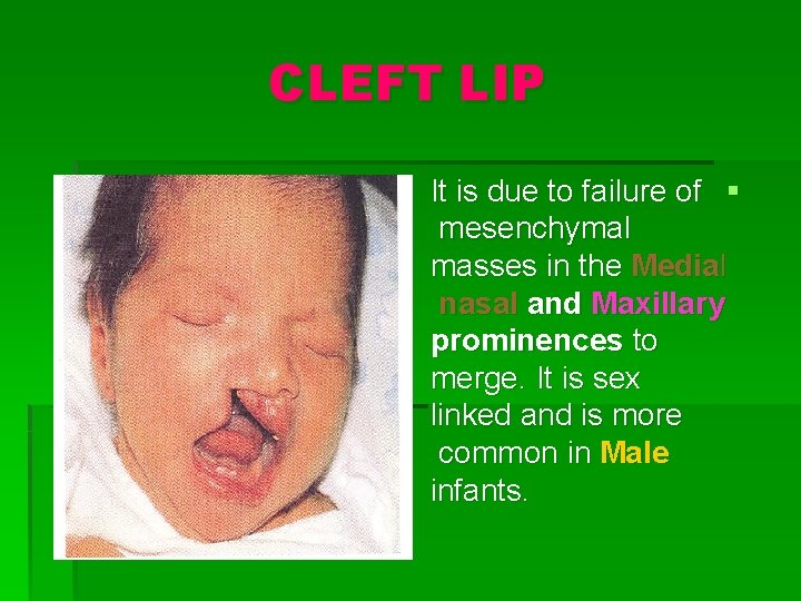 CLEFT LIP It is due to failure of § mesenchymal masses in the Medial
