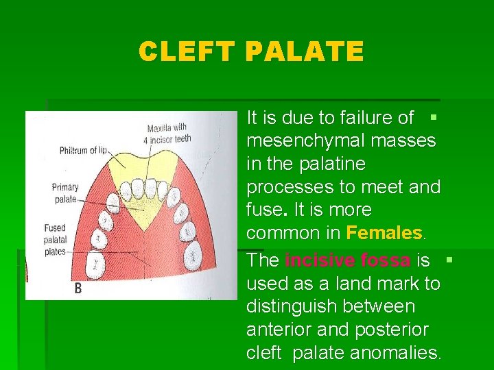 CLEFT PALATE It is due to failure of § mesenchymal masses in the palatine