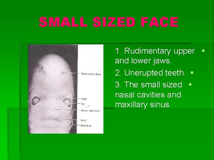 SMALL SIZED FACE 1. Rudimentary upper § and lower jaws. 2. Unerupted teeth. §