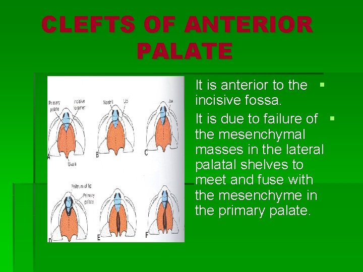 CLEFTS OF ANTERIOR PALATE It is anterior to the § incisive fossa. It is