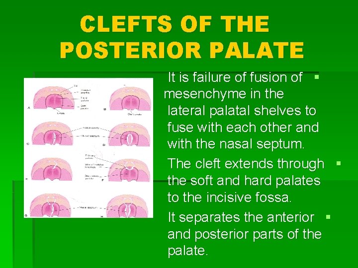 CLEFTS OF THE POSTERIOR PALATE It is failure of fusion of § mesenchyme in