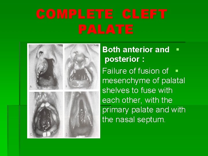 COMPLETE CLEFT PALATE Both anterior and § posterior : Failure of fusion of §