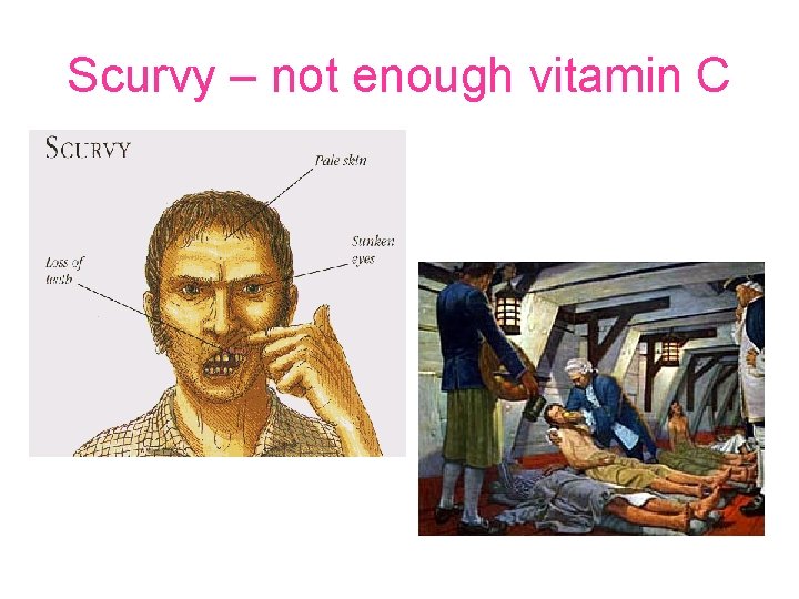Scurvy – not enough vitamin C 