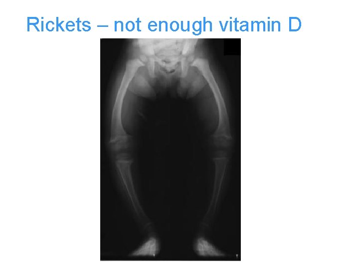 Rickets – not enough vitamin D 