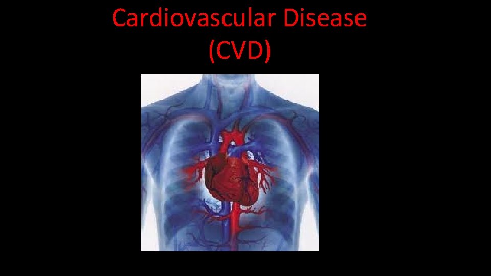 Cardiovascular Disease (CVD) 