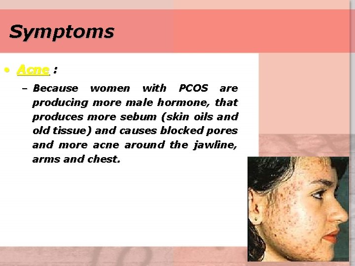 Symptoms • Acne : – Because women with PCOS are producing more male hormone,