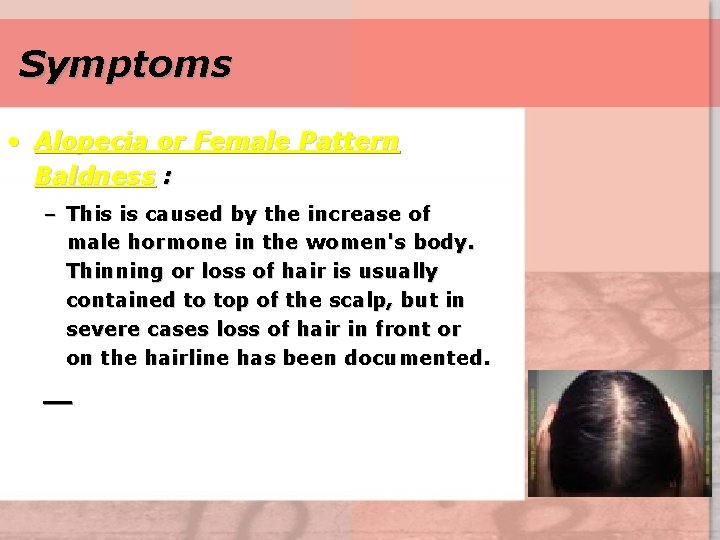Symptoms • Alopecia or Female Pattern Baldness : – This is caused by the