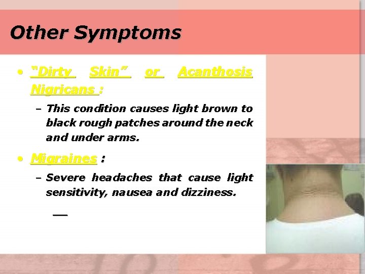 Other Symptoms • “Dirty Skin” Nigricans : or Acanthosis – This condition causes light