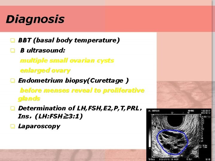 Diagnosis q BBT (basal body temperature) q B ultrasound: multiple small ovarian cysts enlarged