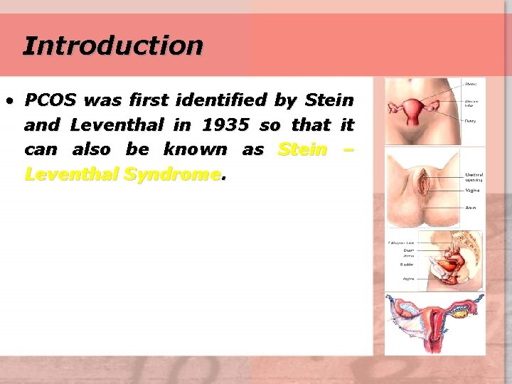 Introduction • PCOS was first identified by Stein and Leventhal in 1935 so that
