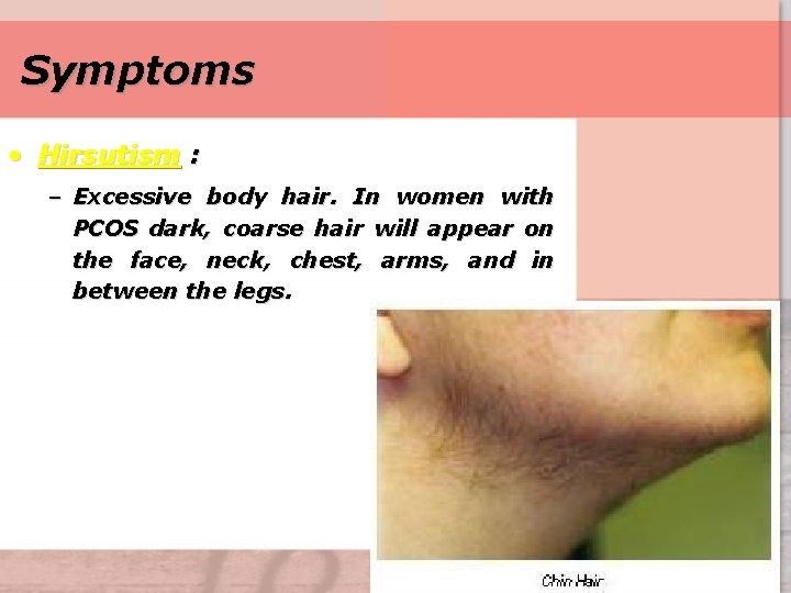Symptoms • Hirsutism : – Excessive body hair. In women with PCOS dark, coarse