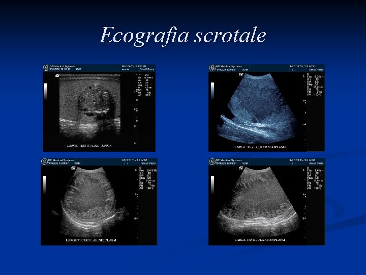 Ecografia scrotale 