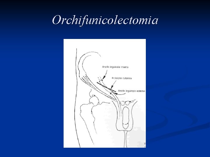 Orchifunicolectomia 