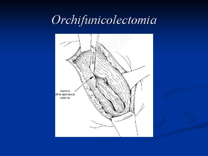 Orchifunicolectomia 