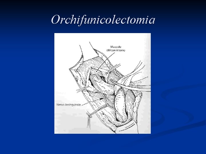 Orchifunicolectomia 