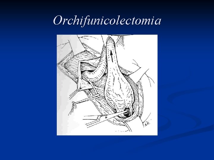 Orchifunicolectomia 