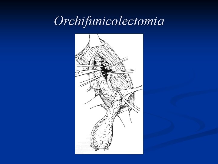 Orchifunicolectomia 