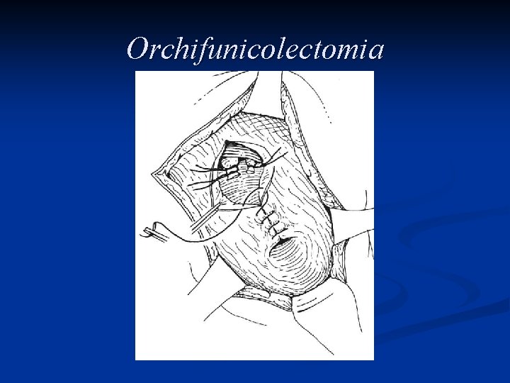 Orchifunicolectomia 