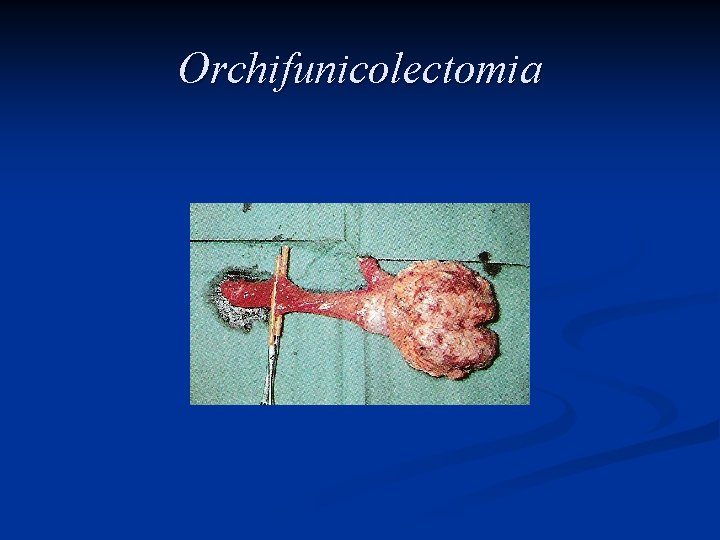 Orchifunicolectomia 