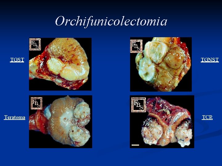 Orchifunicolectomia TGST Teratoma TGNST TCR 