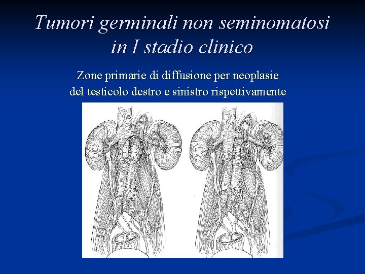 Tumori germinali non seminomatosi in I stadio clinico Zone primarie di diffusione per neoplasie