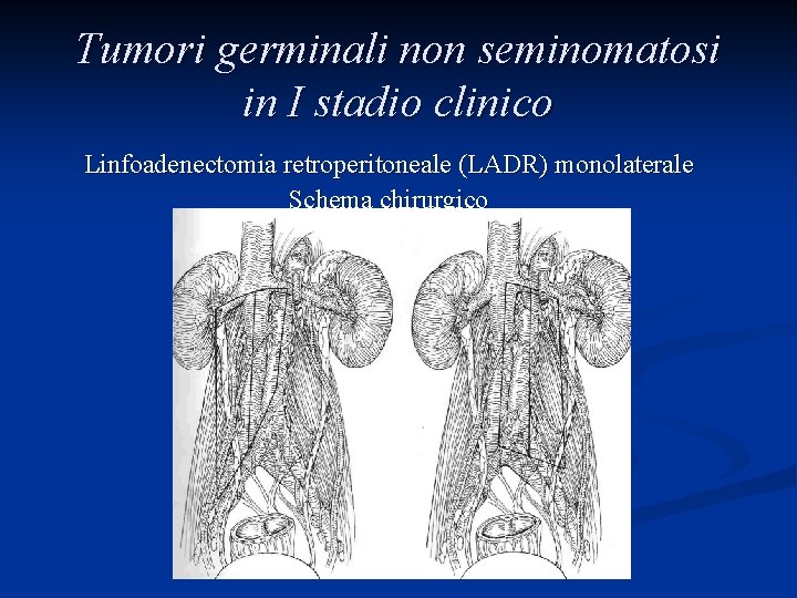 Tumori germinali non seminomatosi in I stadio clinico Linfoadenectomia retroperitoneale (LADR) monolaterale Schema chirurgico