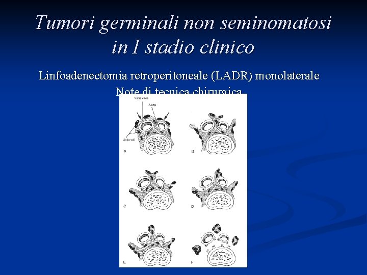 Tumori germinali non seminomatosi in I stadio clinico Linfoadenectomia retroperitoneale (LADR) monolaterale Note di