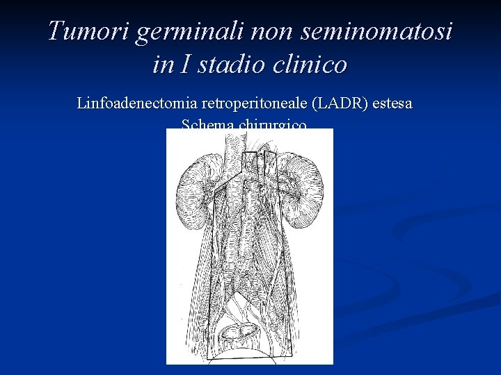 Tumori germinali non seminomatosi in I stadio clinico Linfoadenectomia retroperitoneale (LADR) estesa Schema chirurgico