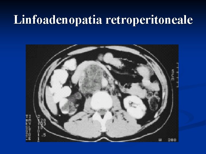 Linfoadenopatia retroperitoneale 