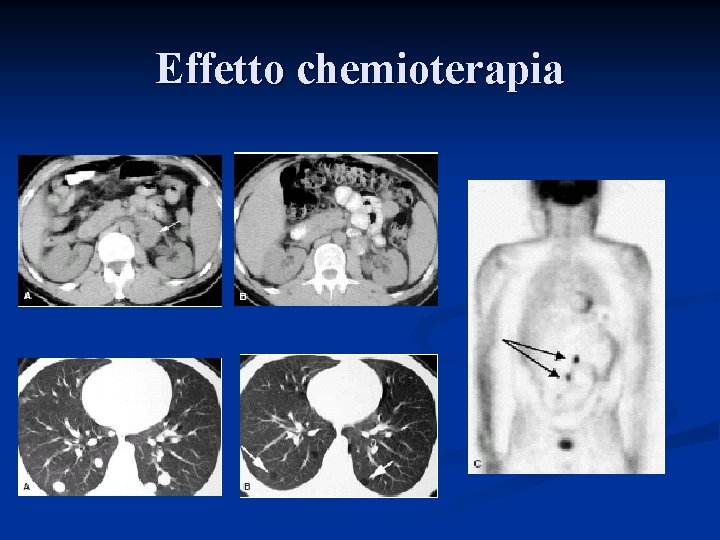 Effetto chemioterapia 