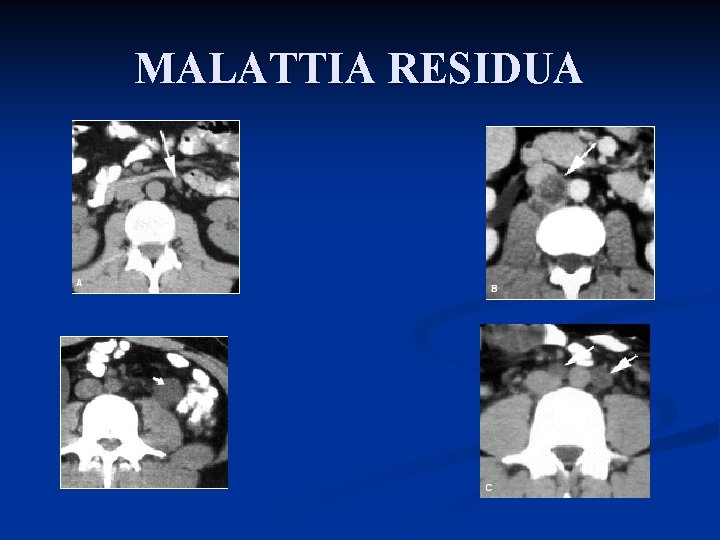 MALATTIA RESIDUA 