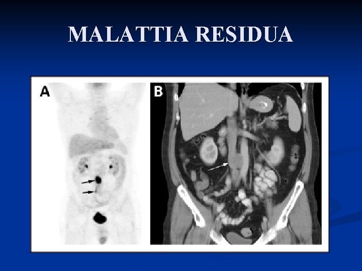 MALATTIA RESIDUA 