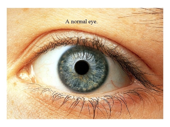 A normal eye. 