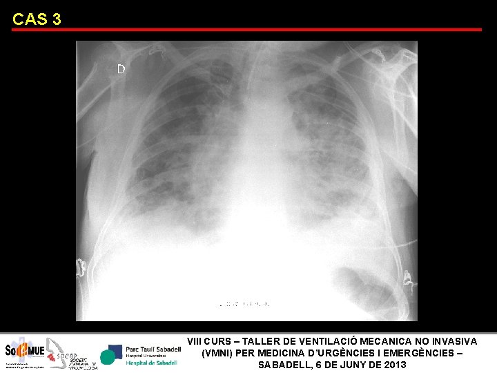 CAS 3 VIII CURS – TALLER DE VENTILACIÓ MECANICA NO INVASIVA (VMNI) PER MEDICINA