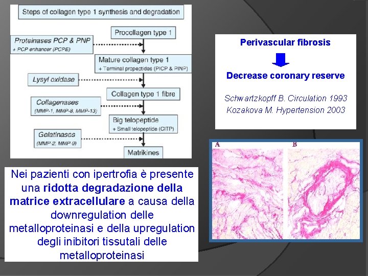 Perivascular fibrosis Decrease coronary reserve Schwartzkopff B. Circulation 1993 Kozakova M. Hypertension 2003 Nei