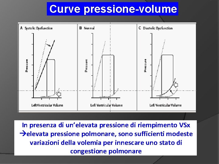 Curve pressione-volume In presenza di un’elevata pressione di riempimento VSx elevata pressione polmonare, sono