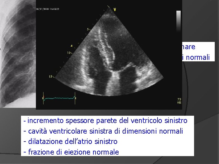 congestione polmonare - cuore di dimensioni normali - incremento spessore parete del ventricolo sinistro