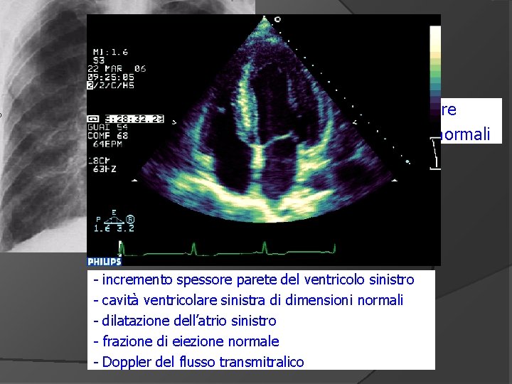 congestione polmonare - cuore di dimensioni normali - - incremento spessore parete del ventricolo