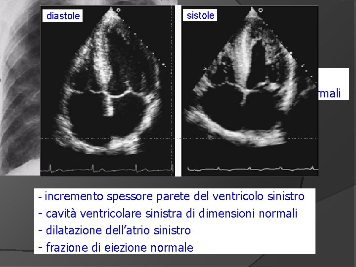 diastole sistole congestione polmonare - cuore di dimensioni normali - incremento spessore parete del