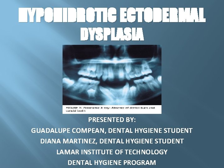 HYPOHIDROTIC ECTODERMAL DYSPLASIA PRESENTED BY: GUADALUPE COMPEAN, DENTAL HYGIENE STUDENT DIANA MARTINEZ, DENTAL HYGIENE