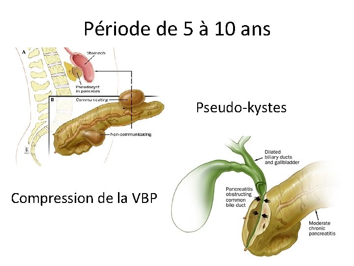 Période de 5 à 10 ans Pseudo-kystes Compression de la VBP 