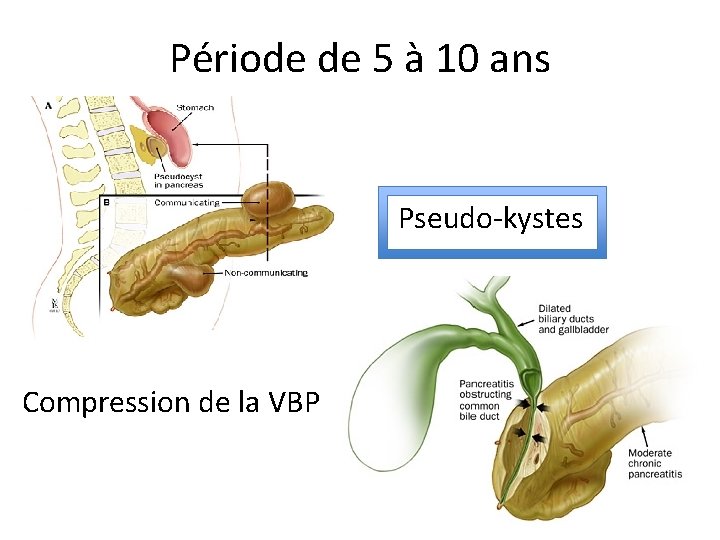 Période de 5 à 10 ans Pseudo-kystes Compression de la VBP 