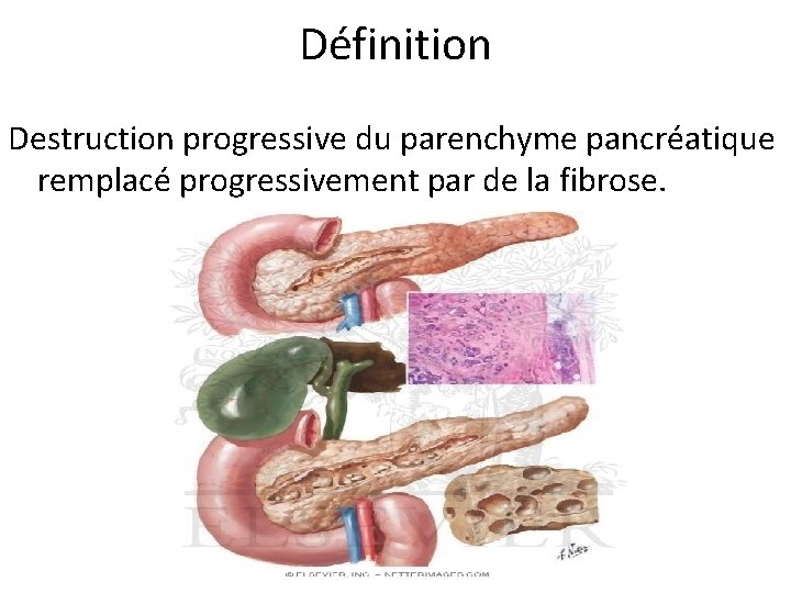 Définition Destruction progressive du parenchyme pancréatique remplacé progressivement par de la fibrose. 