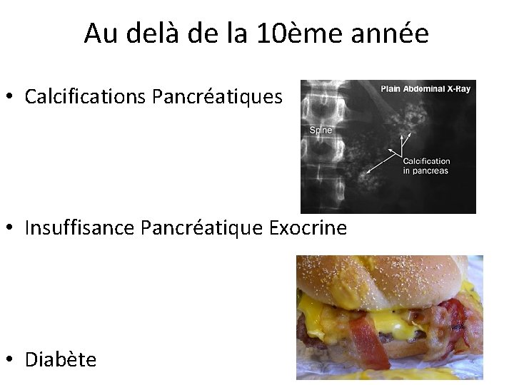 Au delà de la 10ème année • Calcifications Pancréatiques • Insuffisance Pancréatique Exocrine •