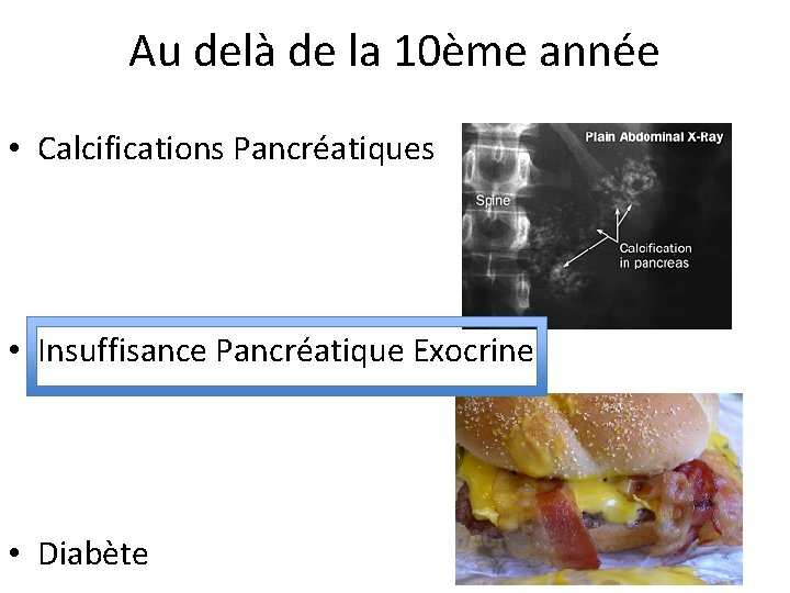 Au delà de la 10ème année • Calcifications Pancréatiques • Insuffisance Pancréatique Exocrine •