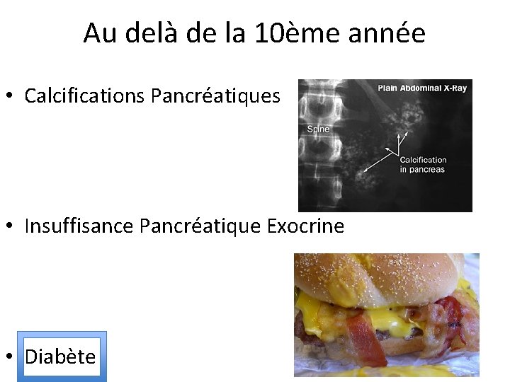 Au delà de la 10ème année • Calcifications Pancréatiques • Insuffisance Pancréatique Exocrine •