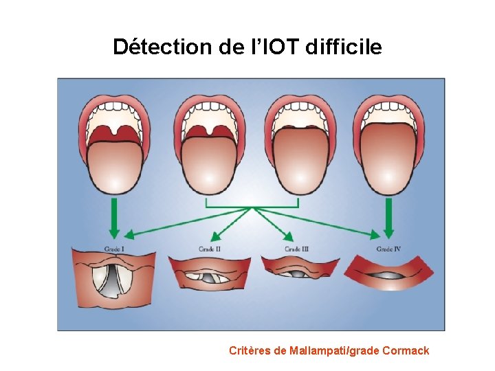 Détection de l’IOT difficile Critères de Mallampati/grade Cormack 