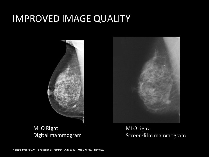 IMPROVED IMAGE QUALITY MLO Right Digital mammogram Hologic Proprietary – Educational Training – July