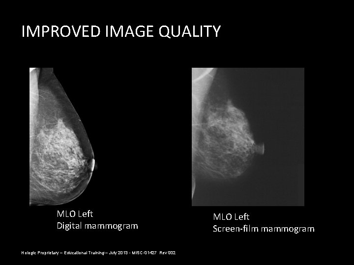 IMPROVED IMAGE QUALITY MLO Left Digital mammogram Hologic Proprietary – Educational Training – July