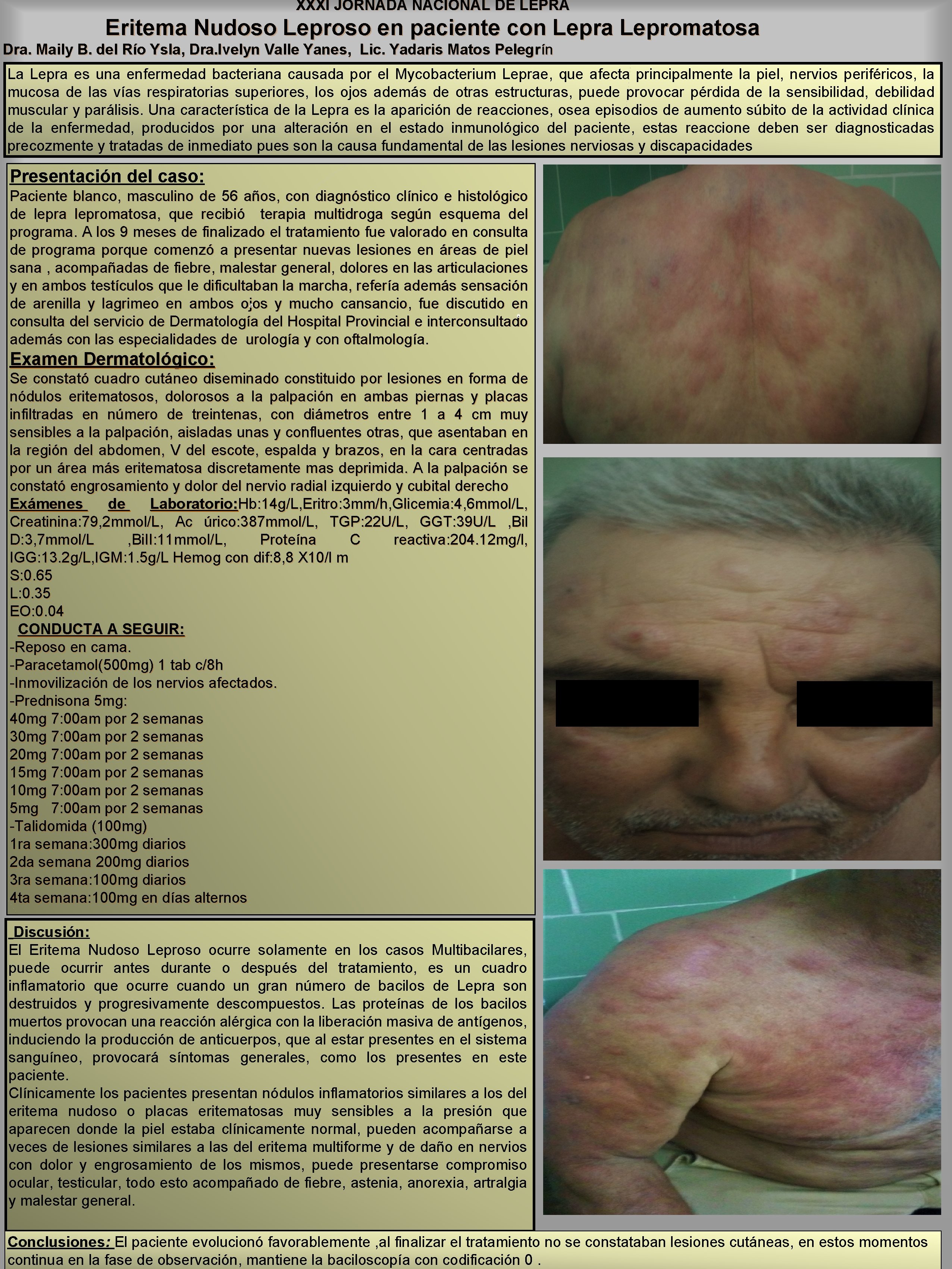 XXXI JORNADA NACIONAL DE LEPRA Eritema Nudoso Leproso en paciente con Lepra Lepromatosa Dra. XXXI JORNADA NACIONAL DE LEPRA Eritema Nudoso Leproso en paciente con Lepra Lepromatosa Dra.